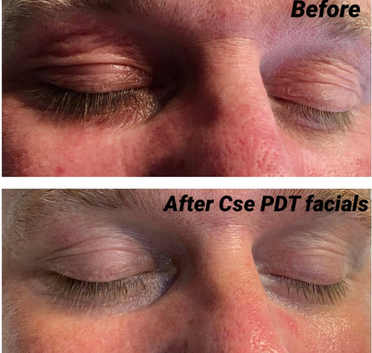 Craig’s Skin Transformation Journey