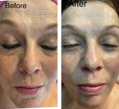 Anti-Aging Skin Rejuvenation Programme  - Real Results