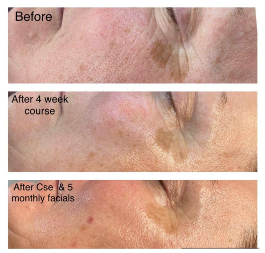 Skin Rejuvenation & Pigmentation - Real Results