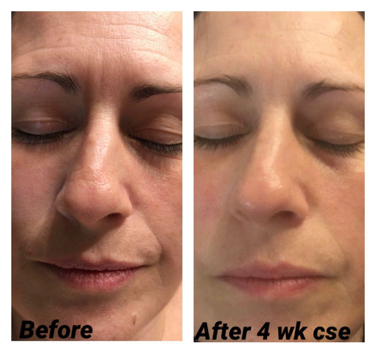 Photo Dynamic LED Facial Treatment - Real Results: Therapist Experience