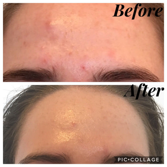 Teen Skin Journey – From Breakouts to Confidence