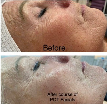 Sharon’s Skin Transformation: From Sensitivity to Radiance at 57
